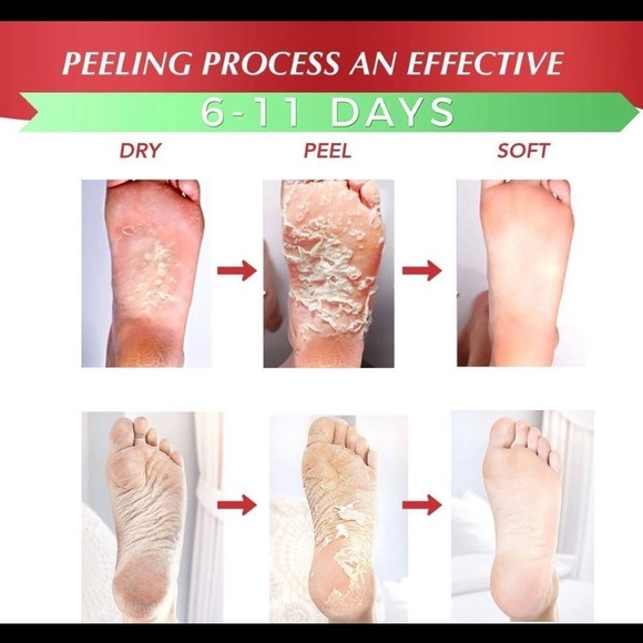 Exfoliating Foot Peel Mask For Softer, Smooth Feet- Gently Peel Away Calluses - Picture 4 of 5